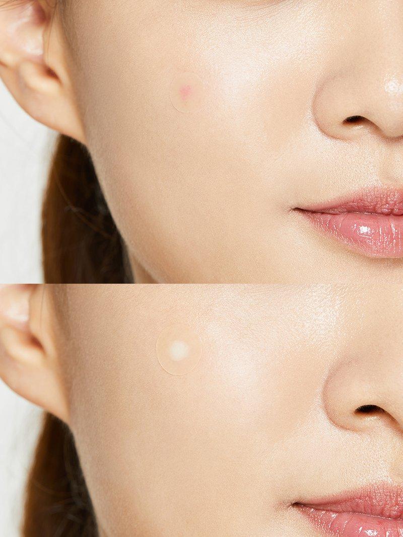 Acne Pimple Master Patch | Parches para acné, 24 parches